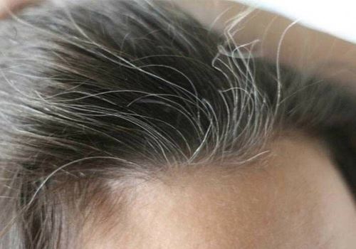 علت سفیدی مو و درمان آن