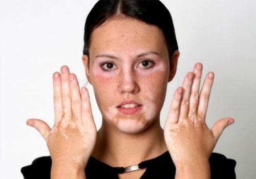 چگونه پیسی پوست خود را درمان کنید